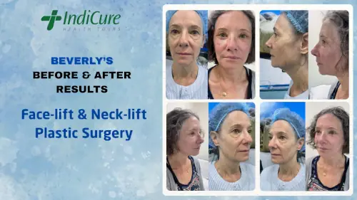 Beverly face and Neck Lift Before and After Pictures
